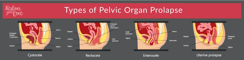 the types of pelvic organ prolapse RYC
