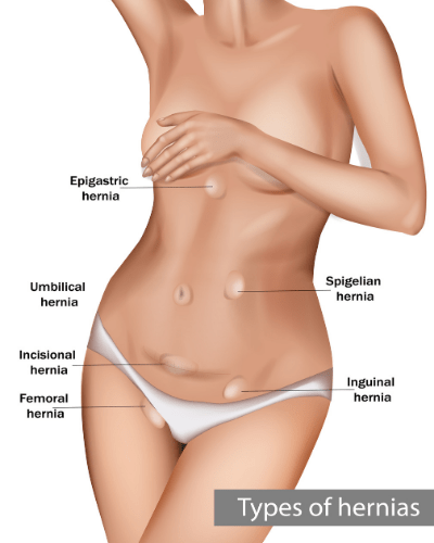 Types of hernias