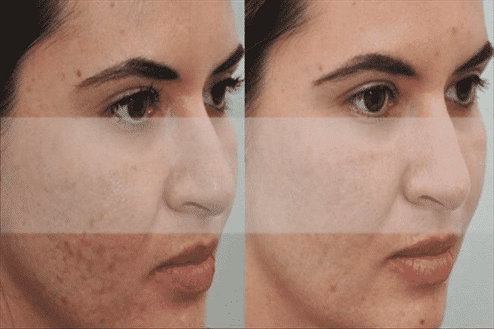 Cicatrizes da acne