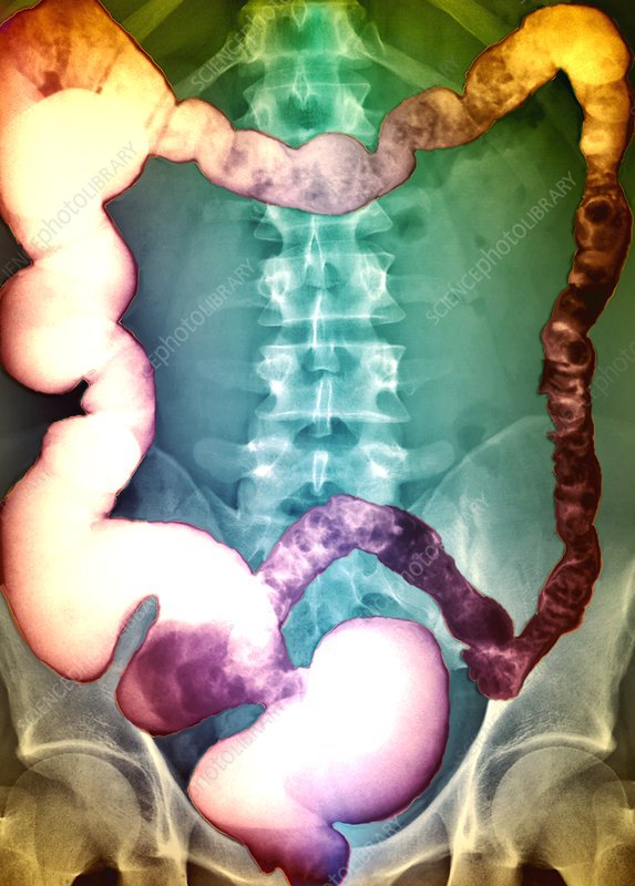 Irritable bowel syndrome, barium X
